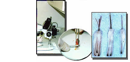 hair transplant photos