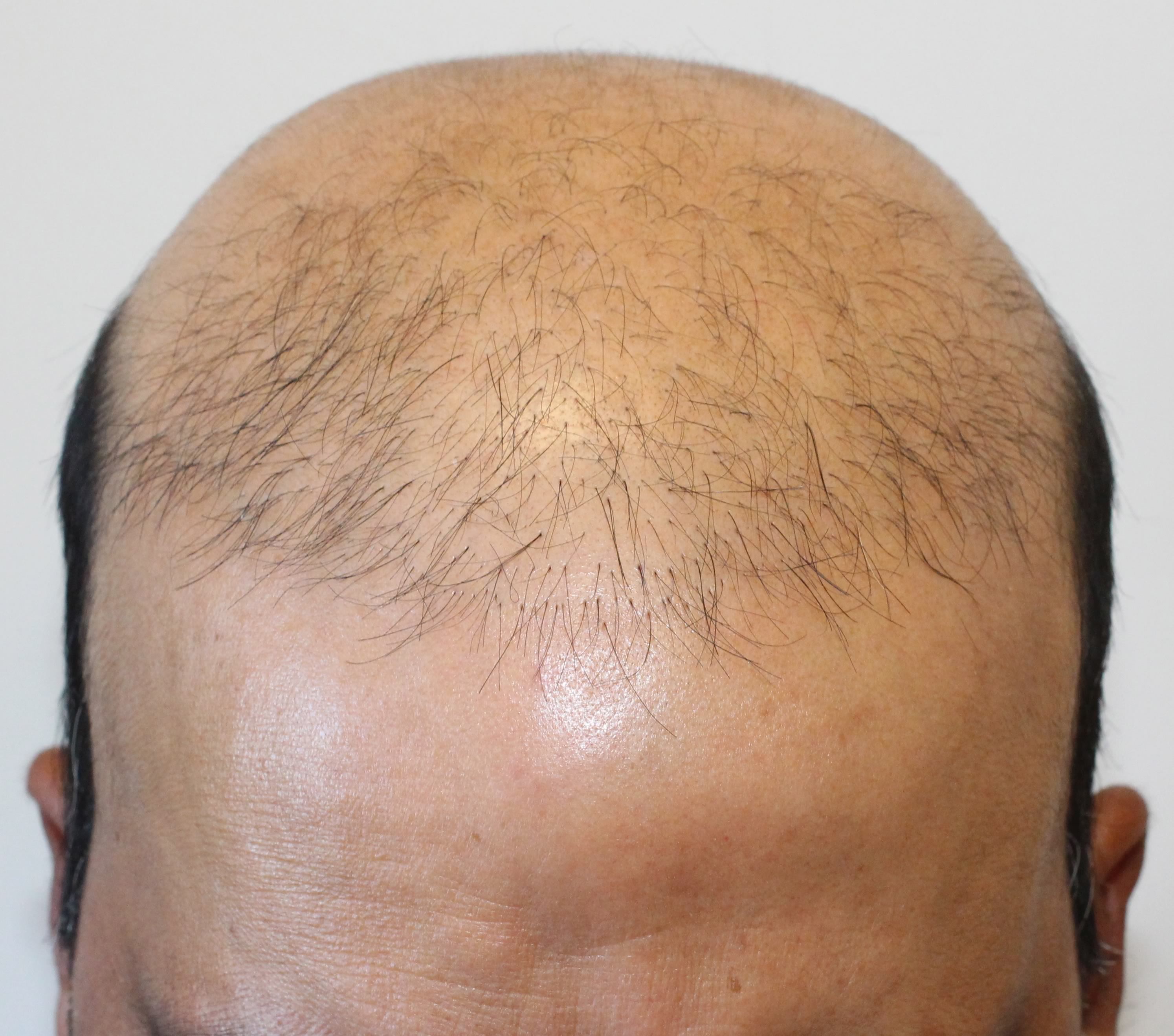 Bad hair transplant